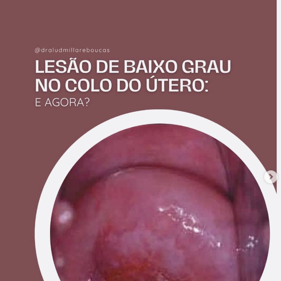 Lesão de baixo grau no colo do útero — conteúdo educativo